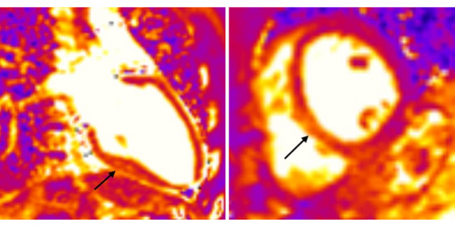 Athletes Have Telltale CMR Markers of Damage Post-COVID-19, but Clinical Significance Unclear